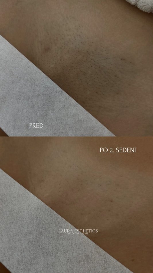 Bikiny pred laserovou epiláciou a po 2. sedení
